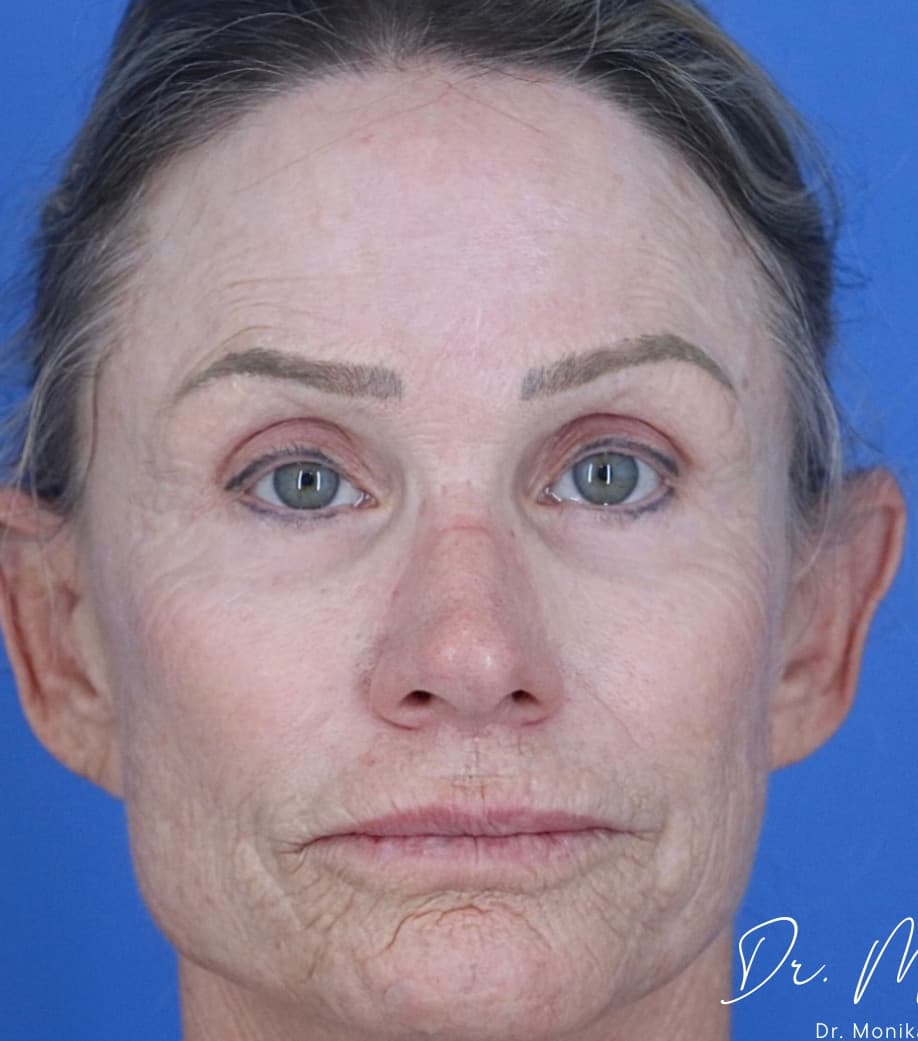 Before: Chemical Peel Before & After Patient #2185