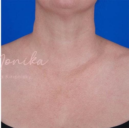 After: Diffuse Redness Before & After Patient #796