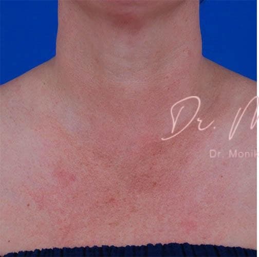 Before: Diffuse Redness Before & After Patient #796
