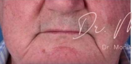 Before: Dysport Before & After Patient #542