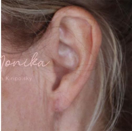 After: Earlobe Repair Before & After Patient #799