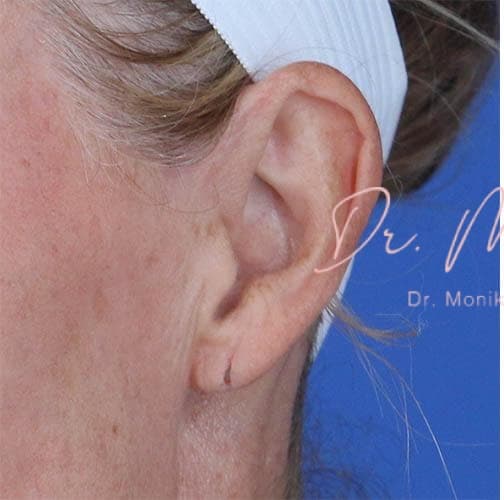 Before: Earlobe Repair Before & After Patient #799
