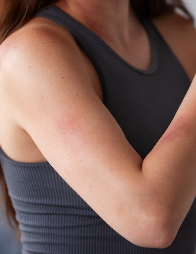Irritated, red skin on an upper arm