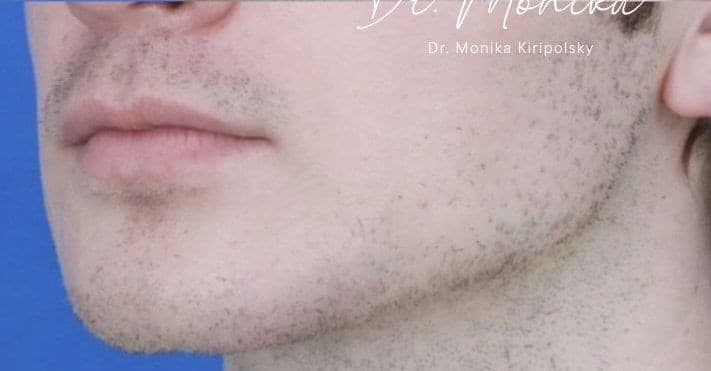 After: Filler Before & After Patient #2239