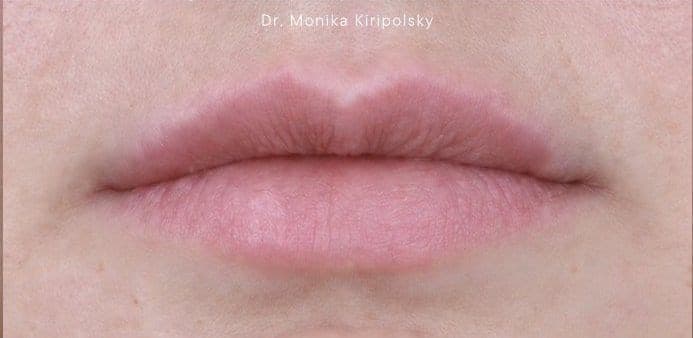 After: Filler Before & After Patient #2239