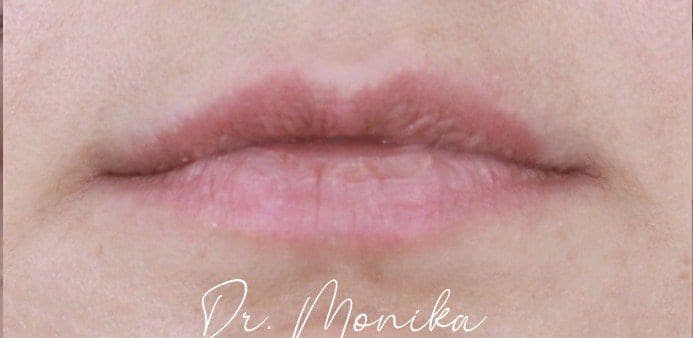Before: Filler Before & After Patient #2239