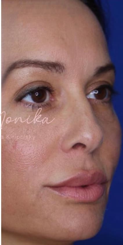 After: Filler Before & After Patient #530