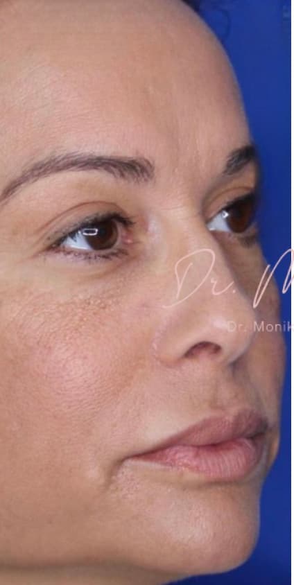 Before: Filler Before & After Patient #530