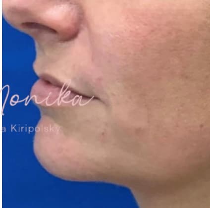 After: Filler Before & After Patient #533