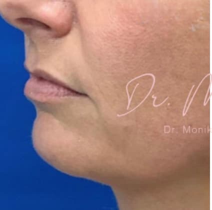 Before: Filler Before & After Patient #533