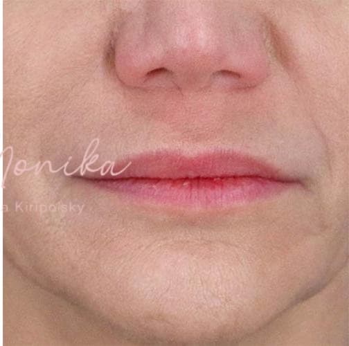 After: Filler Before & After Patient #802