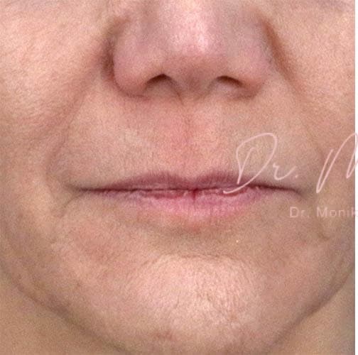 Before: Filler Before & After Patient #802