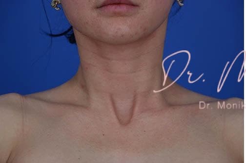 Before: Filler Before & After Patient #805