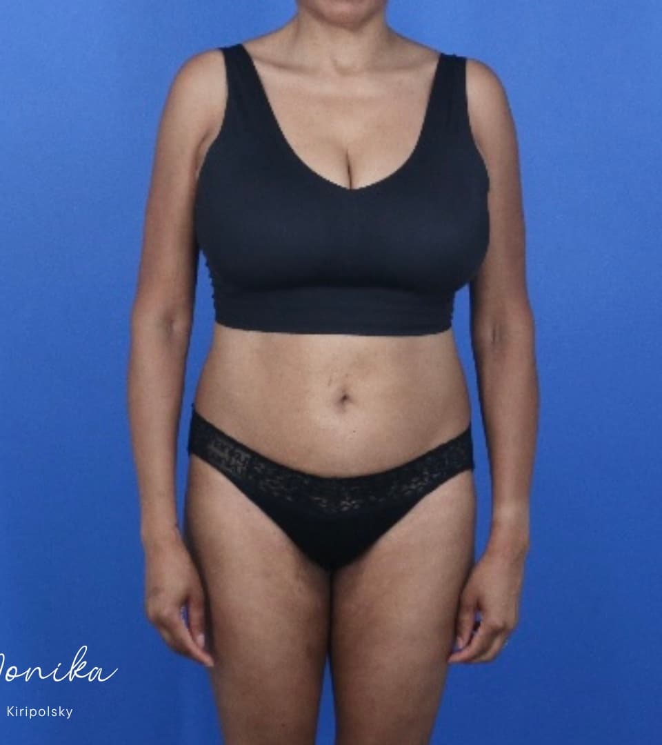 After: GLP-1 Injections Before & After Patient #2184
