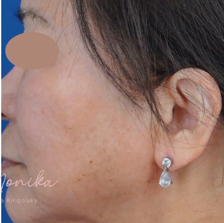 After: Hyperpigmentation Before & After Patient #1633