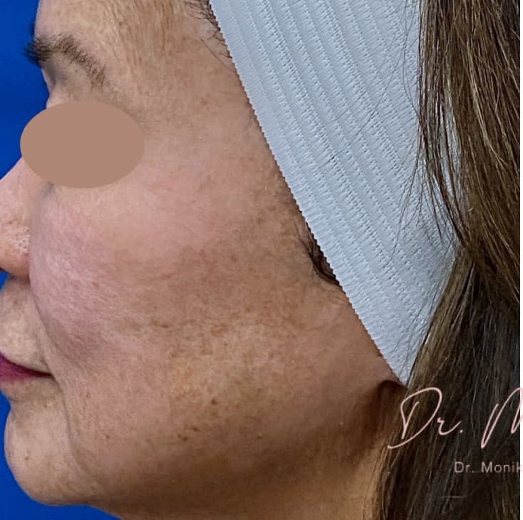Before: Hyperpigmentation Before & After Patient #1633