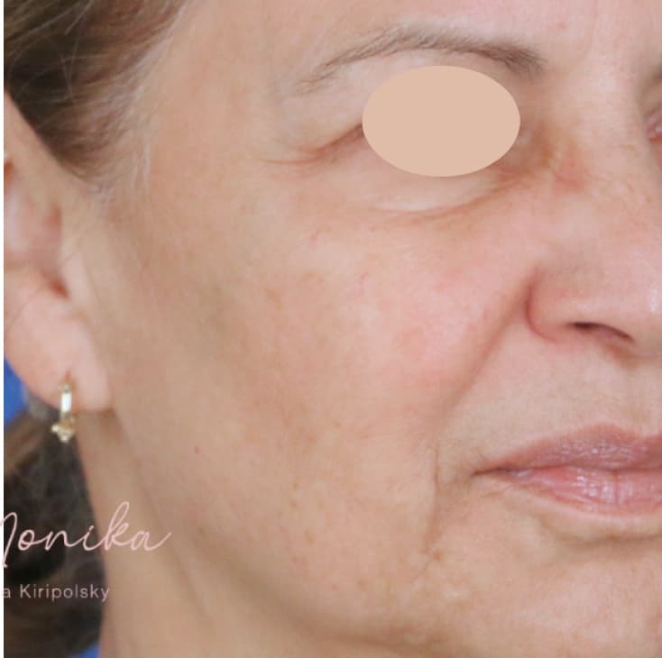After: Hyperpigmentation Before & After Patient #1663