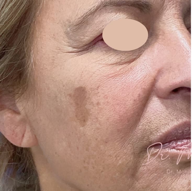 Before: Hyperpigmentation Before & After Patient #1663