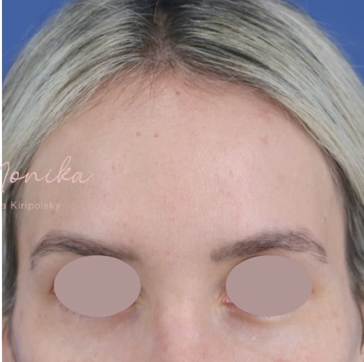 After: Hyperpigmentation Before & After Patient #1664