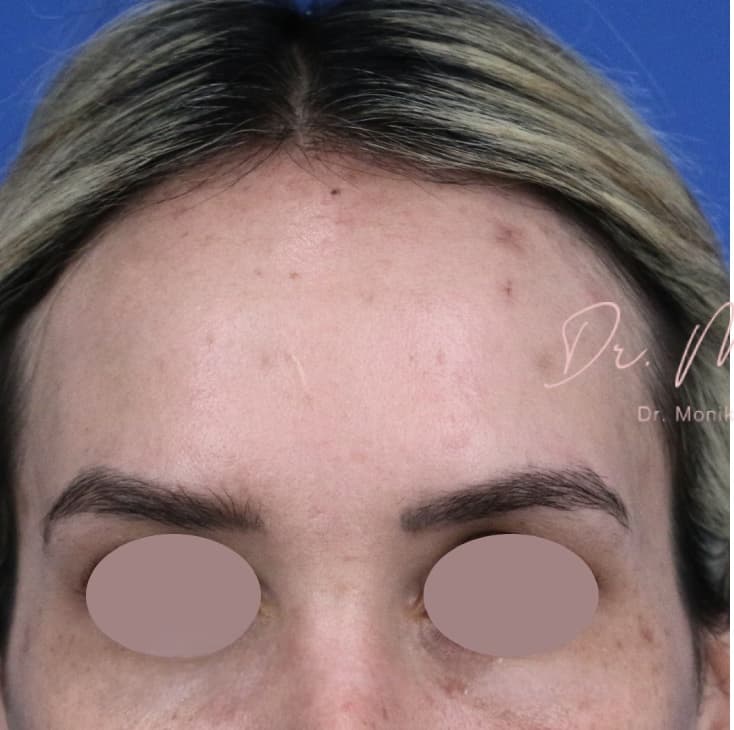 Before: Hyperpigmentation Before & After Patient #1664