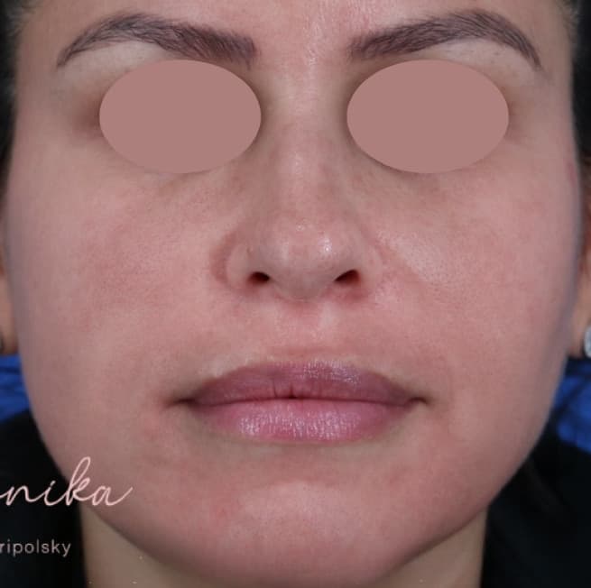 After: Hyperpigmentation Before & After Patient #1666