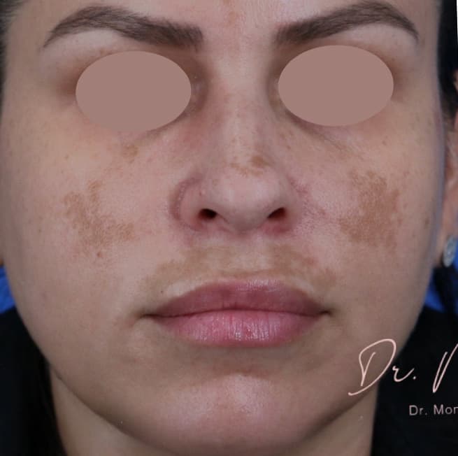 Before: Hyperpigmentation Before & After Patient #1666