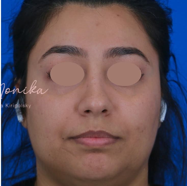 After: Hyperpigmentation Before & After Patient #1667