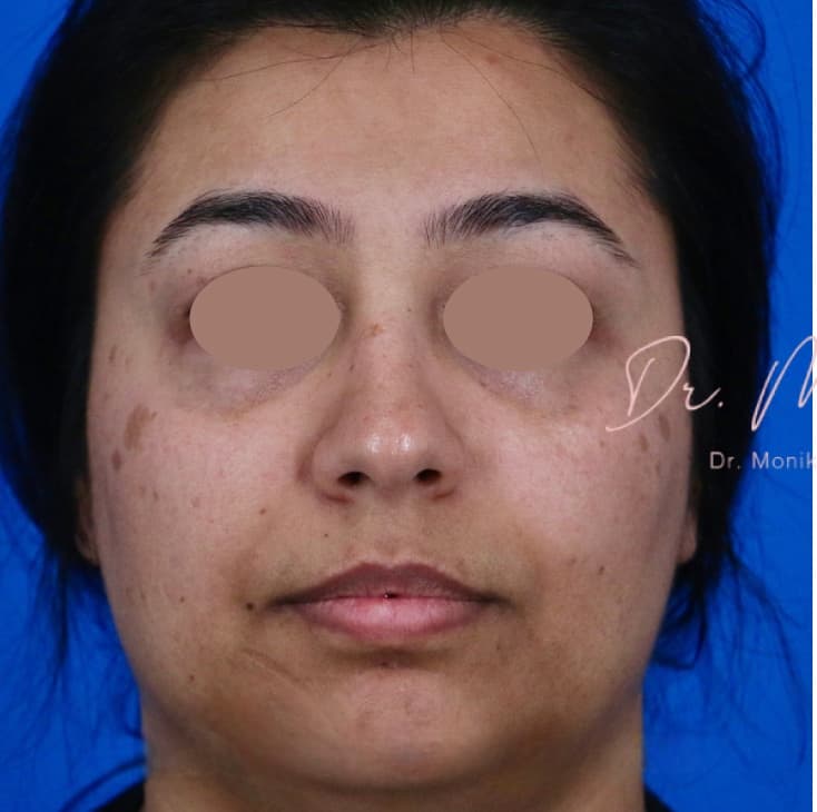 Before: Hyperpigmentation Before & After Patient #1667