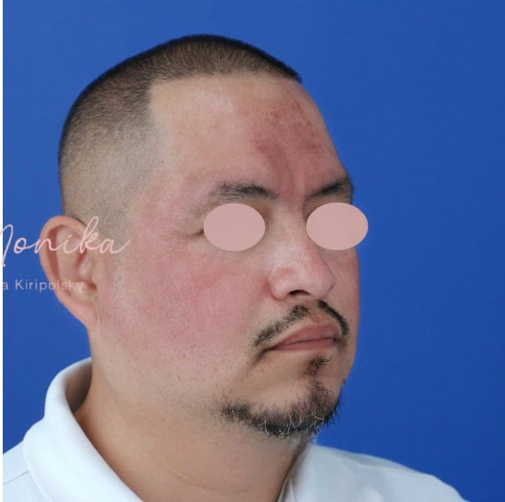 After: Hyperpigmentation Before & After Patient #1726