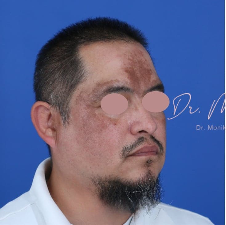 Before: Hyperpigmentation Before & After Patient #1726