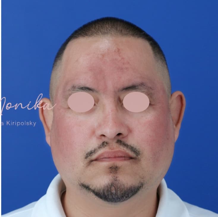 After: Hyperpigmentation Before & After Patient #1726
