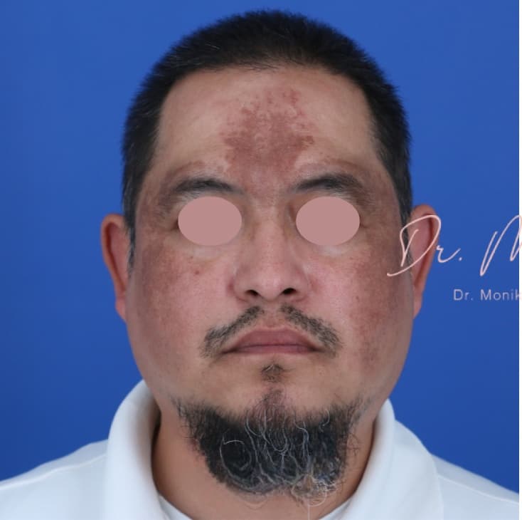 Before: Hyperpigmentation Before & After Patient #1726