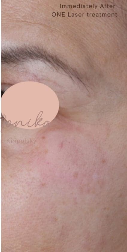 After: Hyperpigmentation Before & After Patient #1727