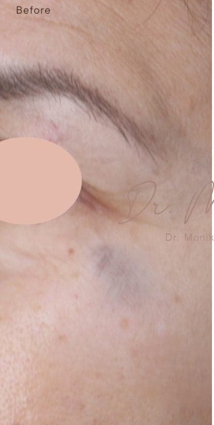 Before: Hyperpigmentation Before & After Patient #1727