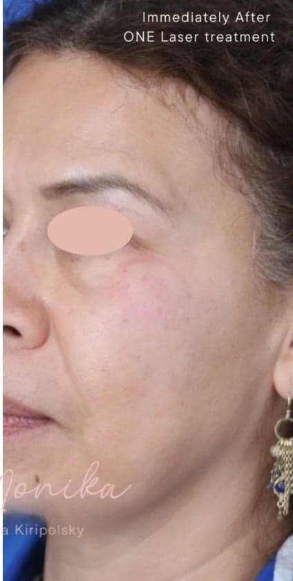 After: Hyperpigmentation Before & After Patient #1727