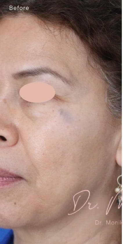 Before: Hyperpigmentation Before & After Patient #1727