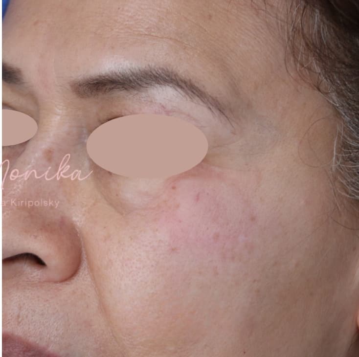 After: Hyperpigmentation Before & After Patient #1727