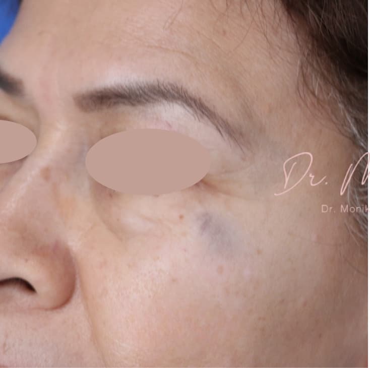 Before: Hyperpigmentation Before & After Patient #1727