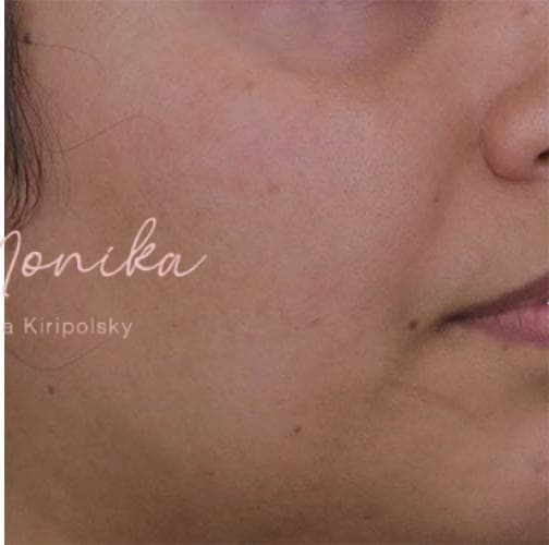 After: Hyperpigmentation Before & After Patient #809