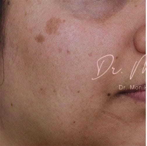 Before: Hyperpigmentation Before & After Patient #809