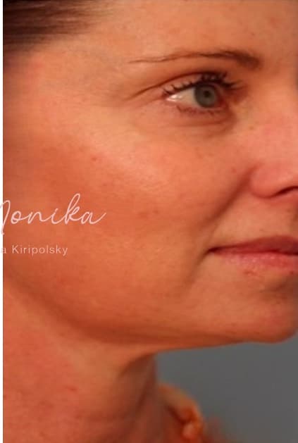 After: Submental Fat Removal Before & After Patient #1532