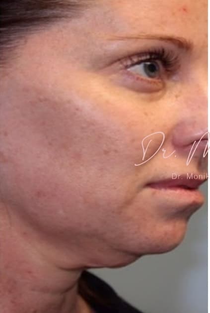 Before: Submental Fat Removal Before & After Patient #1532