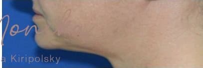 After: Submental Fat Removal Before & After Patient #643