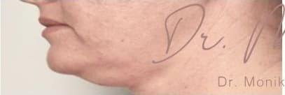 Before: Submental Fat Removal Before & After Patient #643