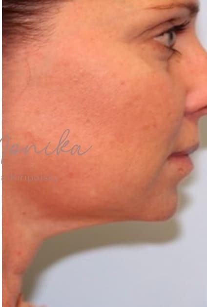 After: Submental Fat Removal Before & After Patient #644