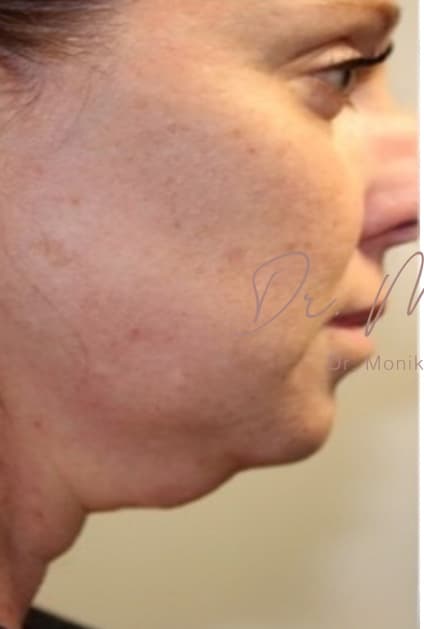 Before: Submental Fat Removal Before & After Patient #644
