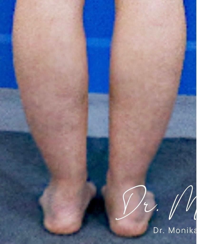 Before: Liposuction / Liposculpture Before & After Patient #2190