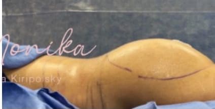 After: Liposuction / Liposculpture Before & After Patient #664