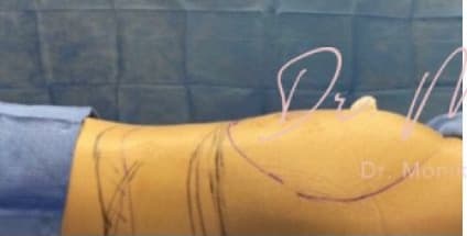 Before: Liposuction / Liposculpture Before & After Patient #664