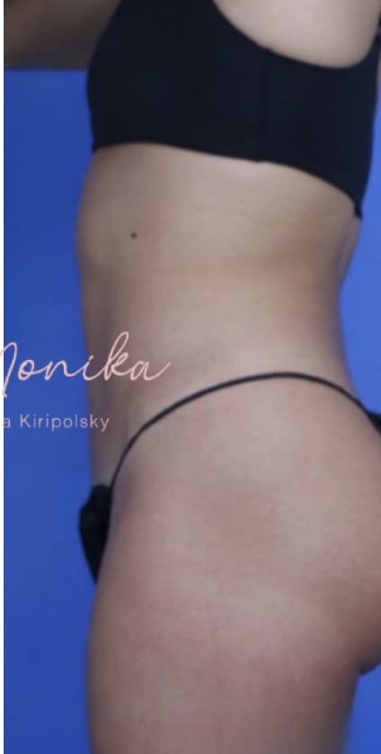 After: Liposuction / Liposculpture Before & After Patient #670